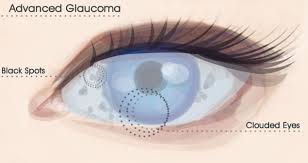 Every eighth Indian above 40 has glaucoma: AIIMS