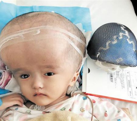 3D printed skull implanted in 3-year-old Chinese girl
